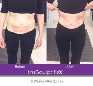 trusculpt flex avon|TruSculpt Flex Body Contouring: Benefits, Before & Afters, Results.